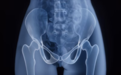 Hip Dislocation in Cerebral Palsy: Why It Happens and How to Prevent It