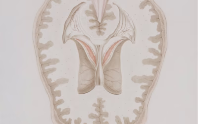 The Four Types of Cerebral Palsy: Spastic, Dyskinetic, Ataxic, Mixed