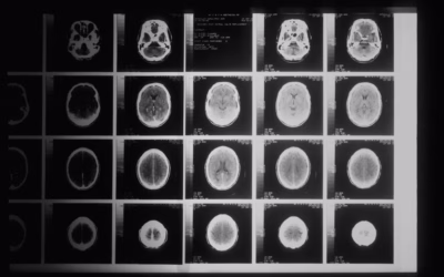 Why Is CP Often Diagnosed Late and How to Push for Earlier Assessment
